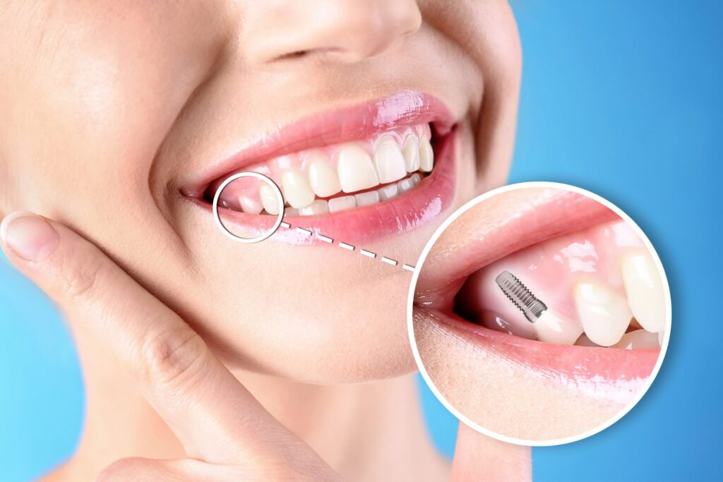 After care dental implants in Pittsburgh PA